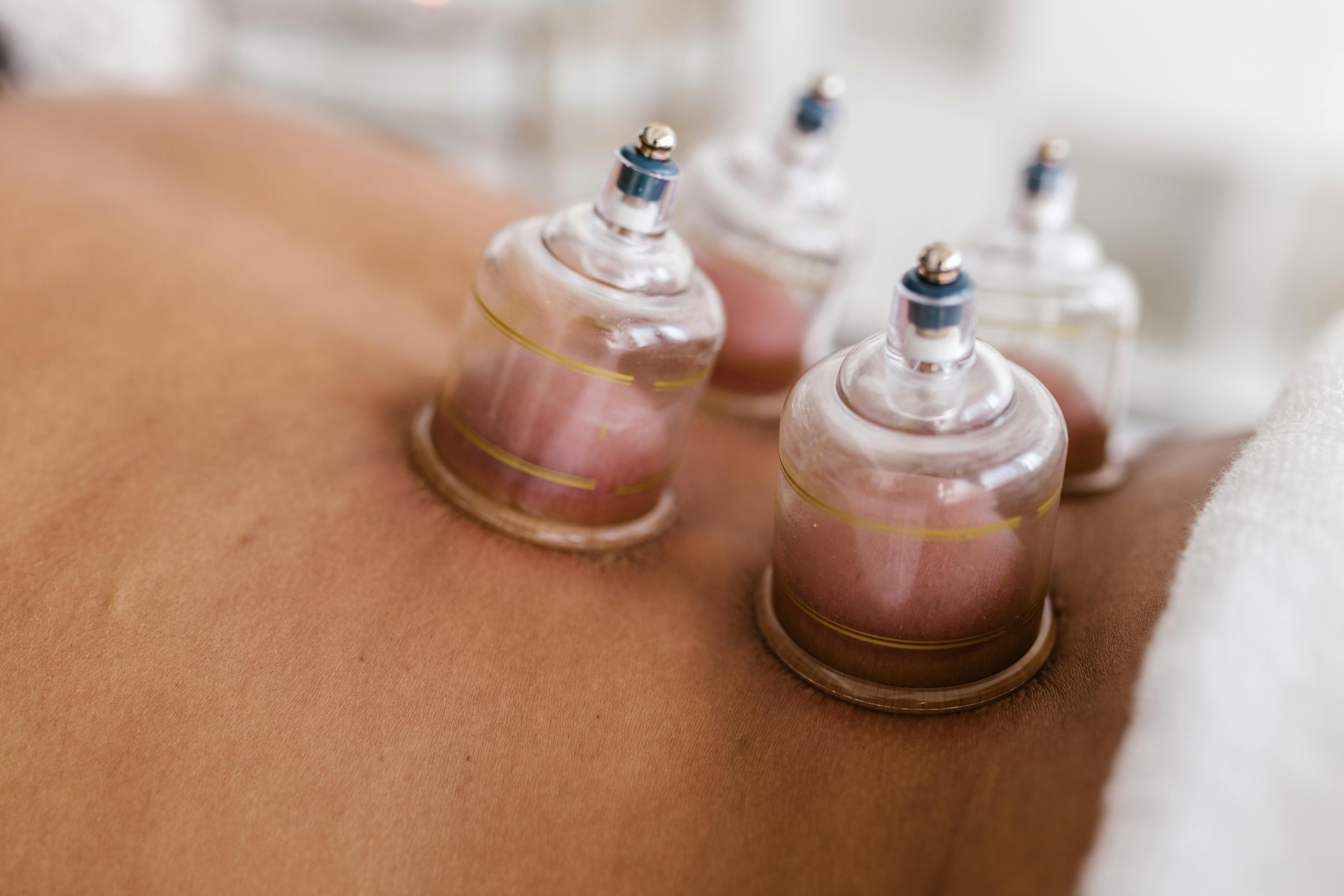 Cupping therapy treatment